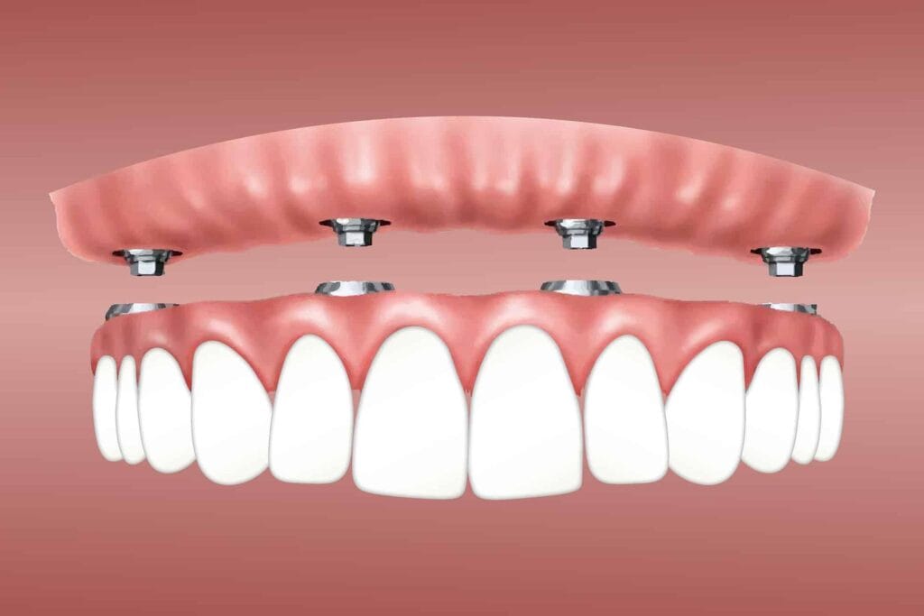 Graphic of a full-arch dental implant