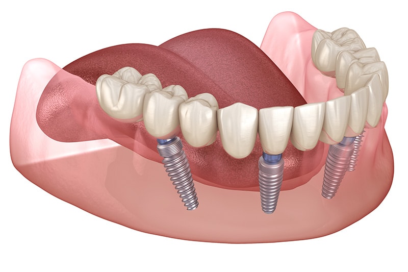 A graphic illustration depicting the attachment of a lower full-arch dental prosthesis and accompanying implants in jaw
