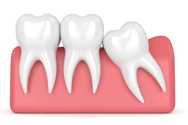 Graphic illustration of an impacted wisdom tooth